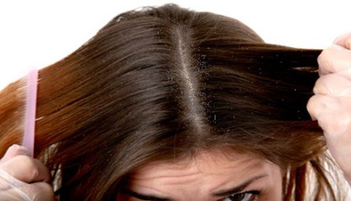 Wie man Schuppen davon abhält, deine Frisur zu zerstören - und deinen Tag 